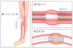 血管の手術