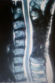 手術後3ヶ月の頚椎MRI-1