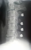 手術後3ヶ月の頚椎-3